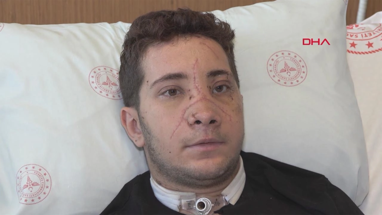 Kaza sonrası burnu kopma noktasına gelen genç, mikro cerrahi ile hayata döndü